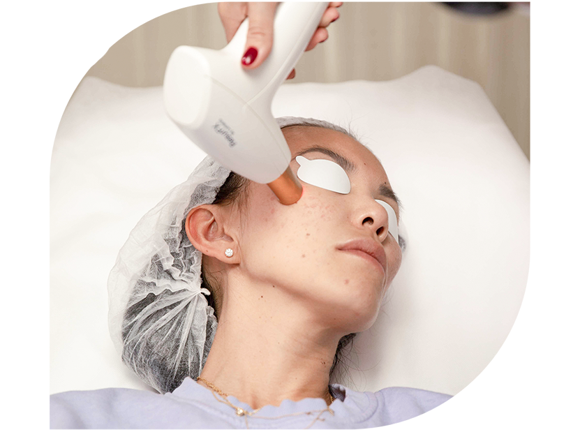 laser resurfacing acne scarring new york